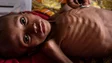 Índice Global da Fome de 2023 revela aumento da subnutrição desde 2017
