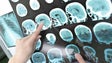 `Esclerose Múltipla` atinge 106 pessoas na Madeira