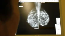 Imagem de Cancro tem aumentado e tem sido detetado mais tarde nos doentes (áudio)