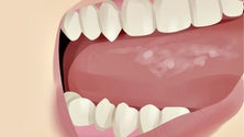 Imagem de Despistes do cancro oral na Madeira referenciaram 14 pessoas com lesões suspeitam em 2022