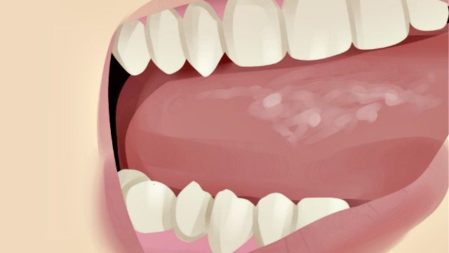 Imagem de Despistes do cancro oral na Madeira referenciaram 14 pessoas com lesões suspeitam em 2022