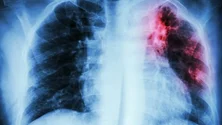 Imagem de Açores entre as regiões com maior mortalidade por pneumonia (Vídeo)
