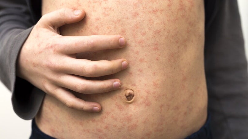 Imagem de Segundo caso de Monkeypox confirmado