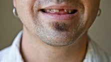 Imagem de Mais de 70% dos portugueses têm falta de dentes