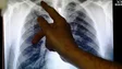 Imagem de Novos casos de tuberculose batem recorde de 7,5 milhões em 2022