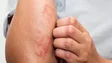 Imagem de Caso de lepra detetado na Madeira