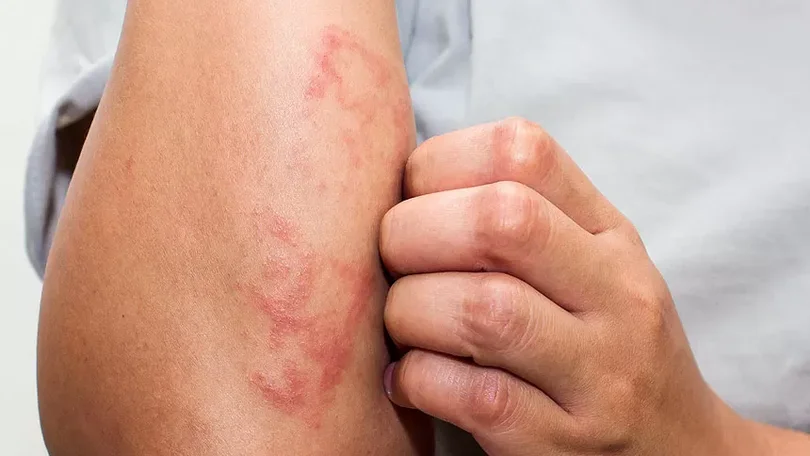 Imagem de Caso de lepra detetado na Madeira