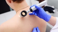Imagem de Mais de 100 casos de cancro de pele em Portugal em 2017