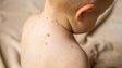 OMS alerta para surtos de sarampo após queda da taxa de vacinação