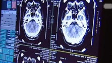 Imagem de Governo reforça ajuda a doentes com Parkinson