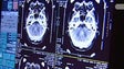 Imagem de Governo reforça ajuda a doentes com Parkinson