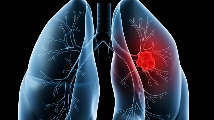 Imagem de Dados do cancro do pulmão mostram melhores resultados dos tratamentos