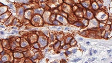 Imagem de Teste genético em todas as mulheres com cancro de mama até os 45 anos