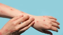 Imagem de Mpox: DGS alarga critérios para vacinção preventiva