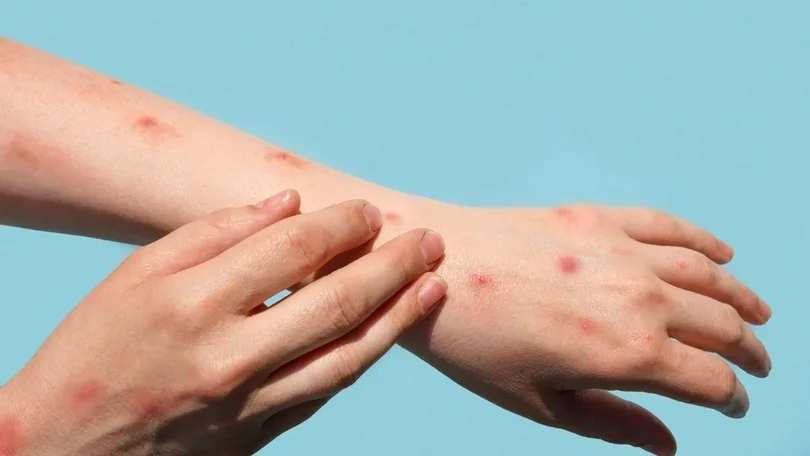 Imagem de Mpox: DGS alarga critérios para vacinção preventiva