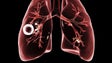 Imagem de Número de casos de tuberculose em Portugal diminuiu (vídeo)