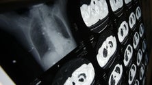 Imagem de Chave para cura de madeirense com cancro raro pode estar na comunidade no Reino Unido