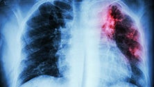 Imagem de Covid causa nova pneumonia  (vídeo)