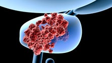 Imagem de Cancro na próstata está a aumentar