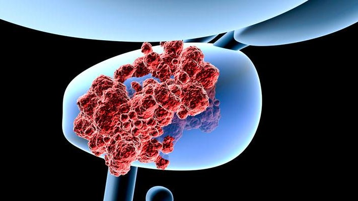 Imagem de Cancro na próstata está a aumentar