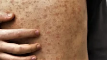 Imagem de Medicamento deverá estar disponível brevemente em maiores quantidades