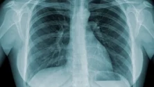 Imagem de Tuberculose matou em Portugal 240 pessoas em 2021