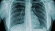 Tuberculose matou em Portugal 240 pessoas em 2021