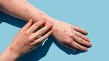 Imagem de Três casos confirmados de Monkeypox na Madeira (áudio)