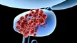 Imagem de Cancro da próstata é o terceiro mais mortal em Portugal (áudio)