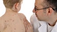 Vacina do Sarampo é ministrada aos 12 meses mas pode ser antecipada se houver surto