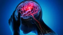 Imagem de Lembrados os doentes com Acidente Vascular Cerebral (Vídeo)