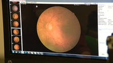 Imagem de Rastreio à retinopatia diabética nos Canhas (vídeo)