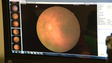 Imagem de Rastreio à retinopatia diabética nos Canhas (vídeo)