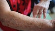 Imagem de Gordura é fator de risco no cancro da pele