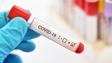 Covid-19: Anticorpos podem subsistir até 12 meses