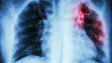 Imagem de Regiões autónomas com prevalência nos doentes com pneumonia (vídeo)
