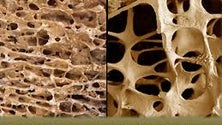 Imagem de Incidência da osteoporose é maior entre a população madeirense