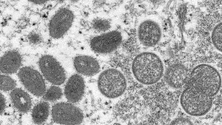 Imagem de Primeiro caso suspeito de Monkeypox na Madeira deu resultado negativo (áudio)