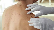 Imagem de Casos de cancro de pele aumentam na Madeira