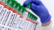 Monkeypox: Número de infeções em Portugal sobe para 770