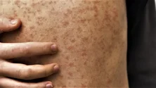 Imagem de Monkeypox: DGS vai avançar com a vacinação preventiva contra a infeção