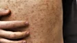 Imagem de Monkeypox: DGS vai avançar com a vacinação preventiva contra a infeção