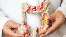 Imagem de Março Azul sensibiliza para o cancro colorretal (áudio)