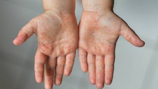 Imagem de Monkeypox: Total de casos confirmados em Portugal sobe para 348