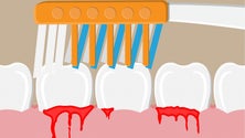Imagem de Sociedade de Periodontologia pede que não se desvalorize sangramento das gengivas