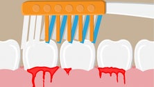 Sociedade de Periodontologia pede que não se desvalorize sangramento das gengivas