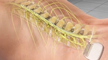 Imagem de Implantes de dispositivos reduzem dor neuropática severa