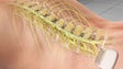 Implantes de dispositivos reduzem dor neuropática severa
