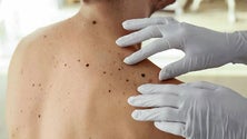 Imagem de Mais 20 casos de cancro da pele (vídeo)
