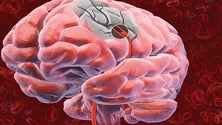 Imagem de Unidade de Doenças Cerebrovasculares abre este mês no Hospital Central do Funchal